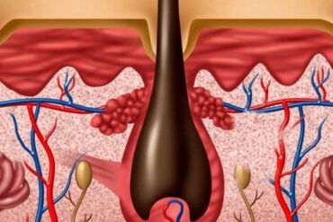 autophagy for loose skin